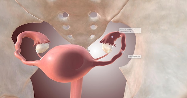 Embryo-implantatie in de eileider