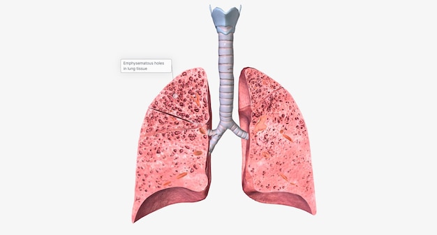 Foto fori enfisematosi nel tessuto polmonare