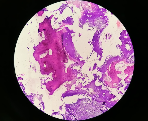 Enchondroma a Benign bone tumor or Microscopic image of enchondroma