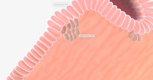 Photo endometrial cancer is a type of cancer that arises from abnormal cells in the endometrial layer