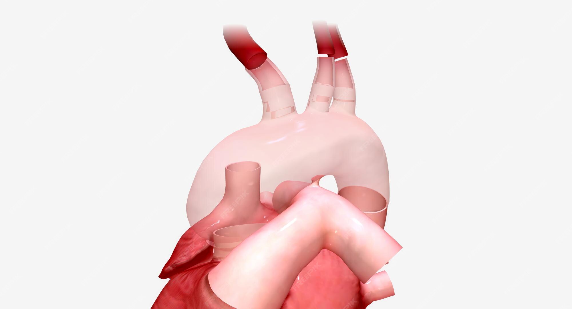 Premium photo | the enlarged portion of the aortic arch is replaced