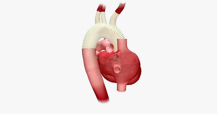 Premium photo | the enlarged portion of the aortic arch is replaced