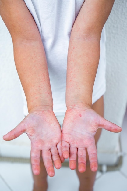 Enterovirus Beenarm mond Uitslag op het lichaam van een kind Cocksackie virus