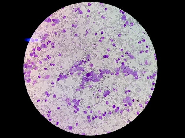 Photo essential thrombocytosis or essential thrombocythemia