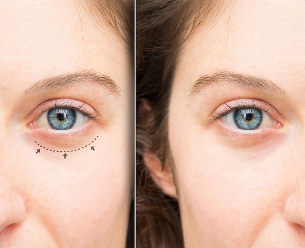 Photo eye bags skin problem correction procedure and treatment