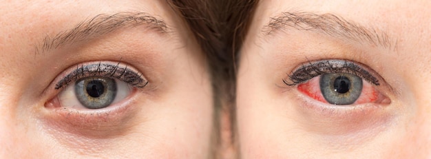 Раздражение глаз до и после применения глазных капель с покраснением и без него