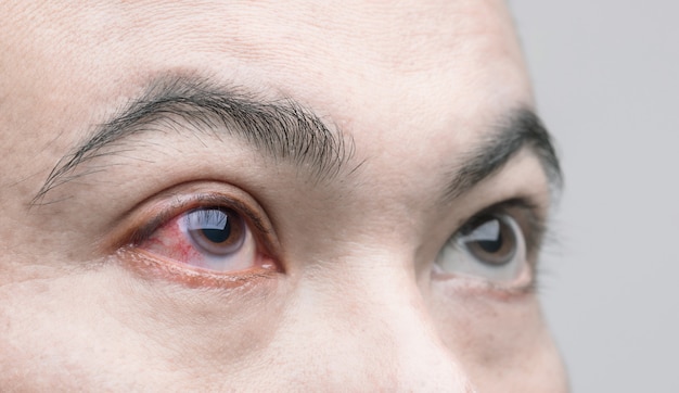 Eye irritation concept : Macro red eye of man,  conjunctivitis eye or after getting dust