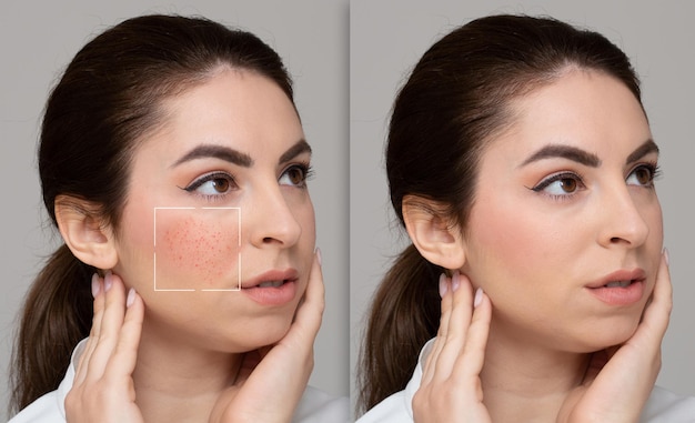 Face of girl suffering from rosacea before and after a treats