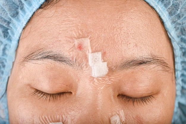 Foto problema della pelle del viso malattia dell'acne nell'adulto primo piano del viso della donna con brufoli bianchi viso grasso e grasso arrossamento bruciato e cicatrice gonfiore dopo il trattamento laser dell'acne