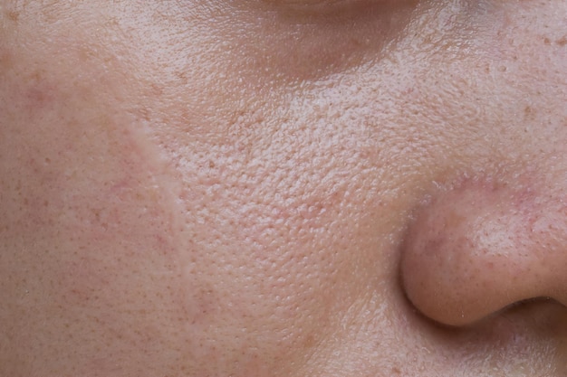 fair skin with wide pores in face of southeast asian myanmar or korean adult young woman
