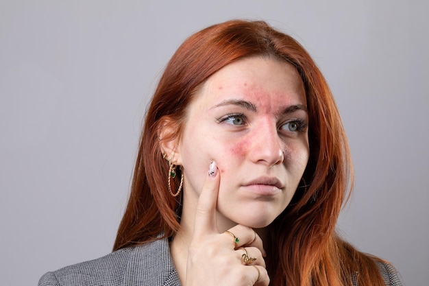Фото Молодая женщина со светлой кожей, страдающая розацеа покраснение лица из-за купероза