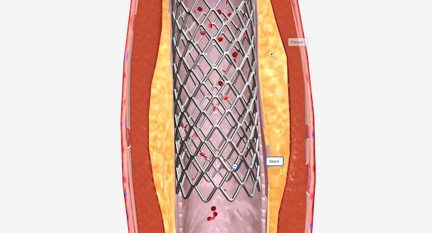 Photo fat layer accumulating in arteries