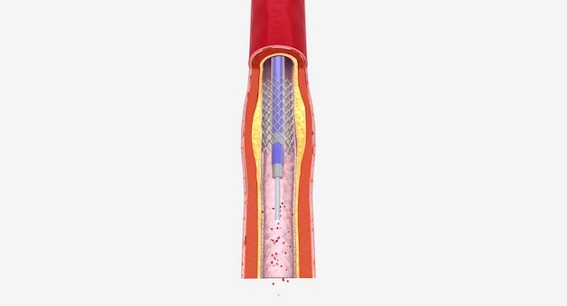 Photo fat layer accumulating in arteries