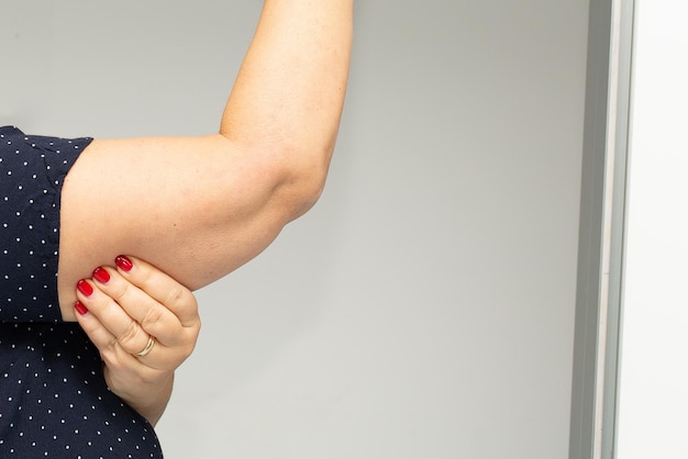 중년의 과체중 여성의 팔에 있는 지방 조직