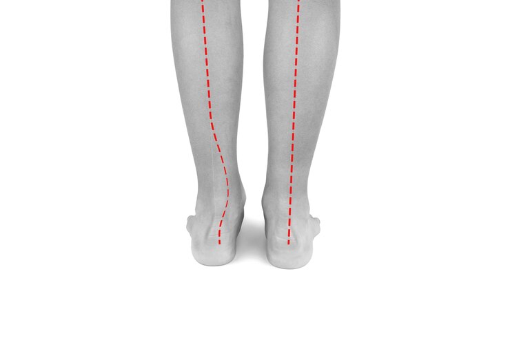 Feet of a boy with flat feet or a dropped arch the ankle is tilted inward The red line shows abnormal forms of flat feet compared to the norm Hallux valgus