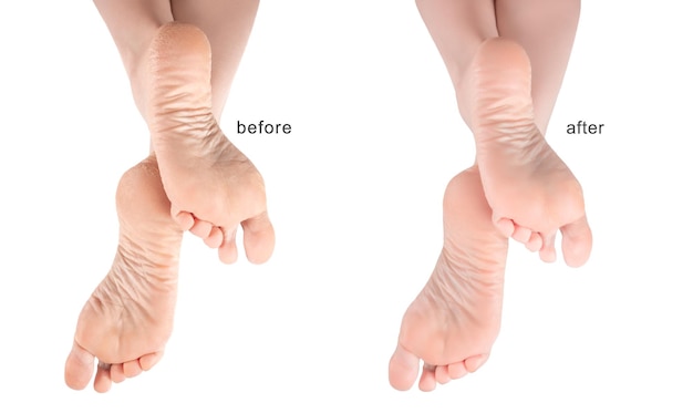 Feet with dry skin before and after treatment dry chapped skin on feet requiring care isolated on white background dry skin on heels and soles needs care