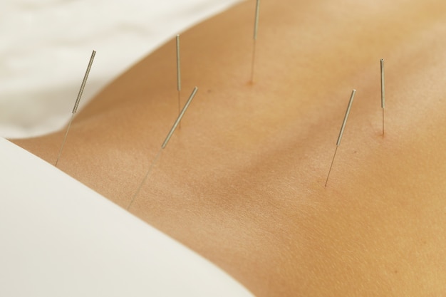 Dorso femminile con aghi in acciaio durante la procedura di terapia di agopuntura