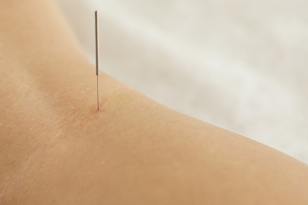 Female back with steel needles during procedure of acupuncture therapy