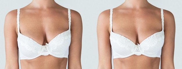 Female breast comparison before and after breast asymmetry correction surgery