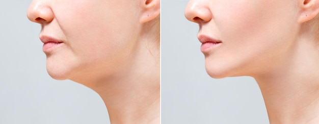 female double chin before and after correction correction of the chin shape liposuction of the neck the result of the procedure in the clinic of aesthetic medicine