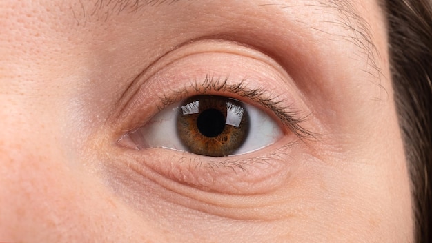 Female eye closeup keratoconus disease of the cornea