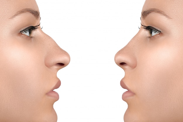 Female face before and after cosmetic nose surgery