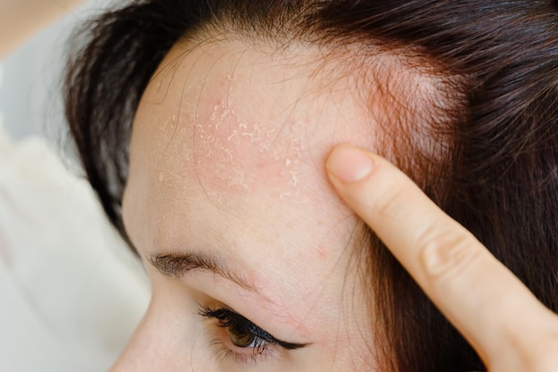 Female face with burned skin after chemical peeling