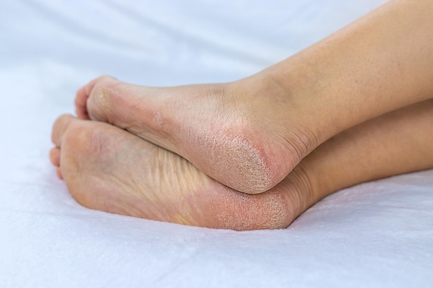 Female feet dry skin on the heels Selective focus