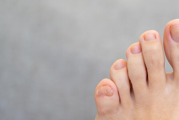 Female feet with big double little toe on grey background