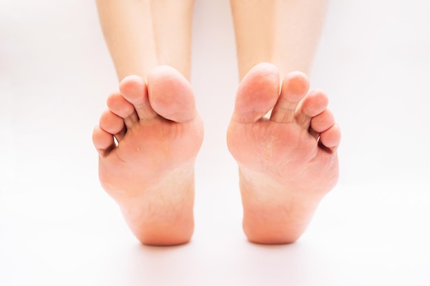 薄片状の皮膚と白い背景の上のトウモロコシを持つ女性の足真菌感染症湿疹乾癬