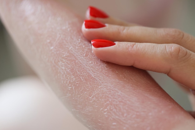 Female fingers with red manicure touch the skin on hand