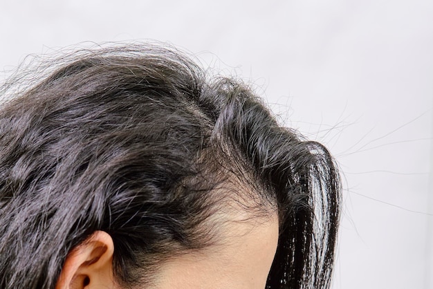 Female hairloss problems