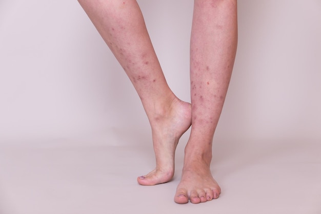 24+ 足 に 赤い 斑点 画像 8 足に多くの赤い斑点と傷跡の虫刺されを持つ女性の足 | プレミアム写真