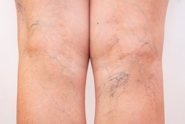 Gambe femminili con vene varicose e ragni delle gambe.