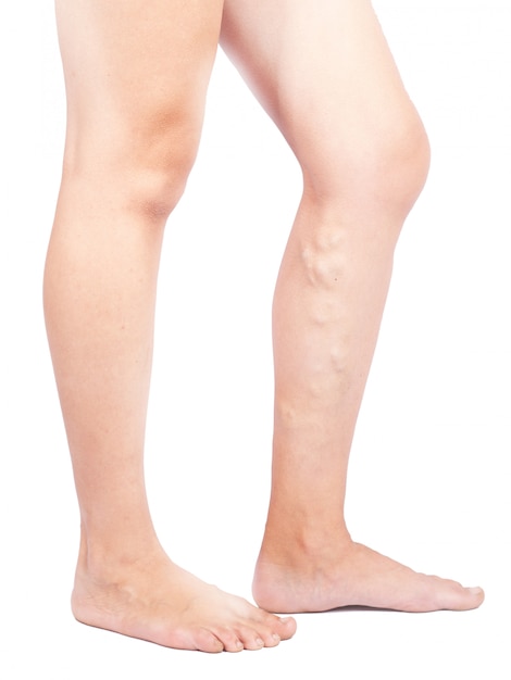 female legs with varicose veins on white background