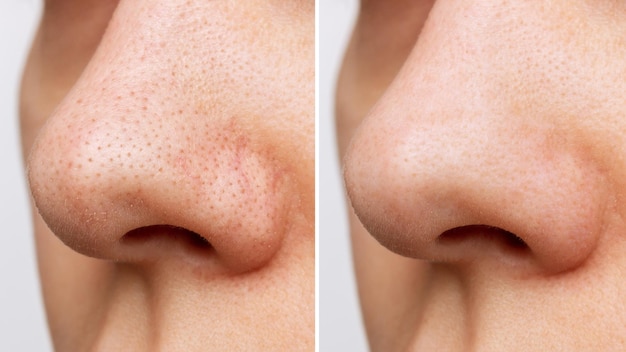 Naso femminile con punti neri o punti neri prima e dopo il peeling e la pulizia del viso