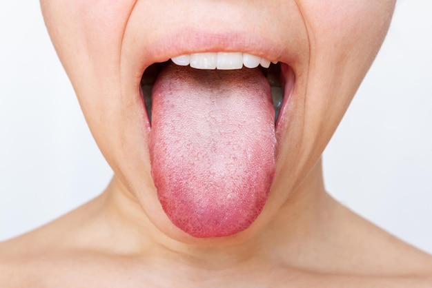 흰색 플라크와 여성 혀 흰색 배경에 고립 된 혀를 보여주는 젊은 여자