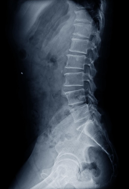 Film x-ray L-S spine lateral views showing Compression fracture L1 vertebral body. Medical image concept.