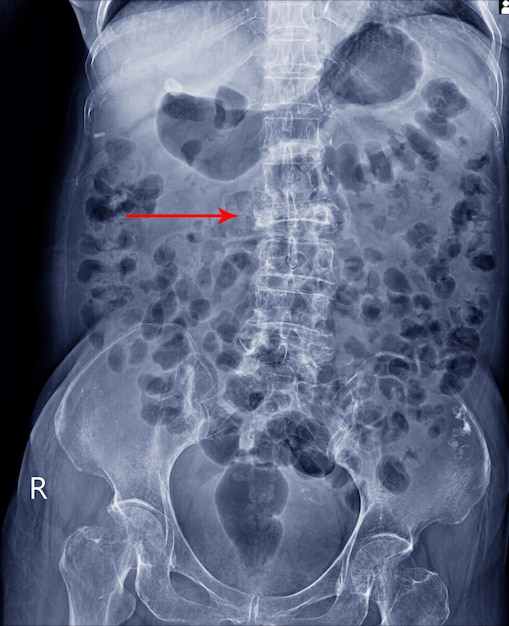 Foto vista ap della colonna vertebrale ls a raggi x del film che mostra la frattura da scoppio del corpo vertebrale l2 con grave collasso vertebrale, concetto di immagine medica.