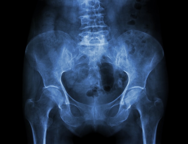 Photo film x-ray pelvis of osteoporosis patient