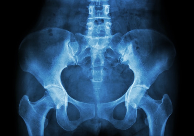 Film X-ray of Pelvis