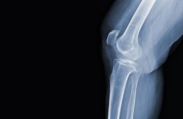 Film xray of human knee normal joints and ligaments Medical image concept