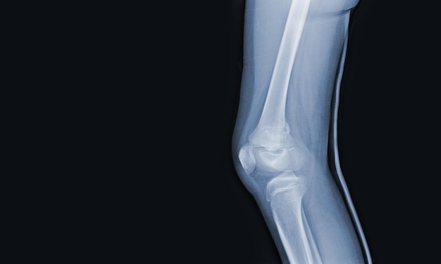 Film xray of human knee showing closed fractureright distal\
femur normal joints and ligaments medical image concept