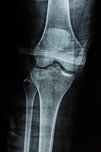 Film Xray of a leg bone person Film grain style