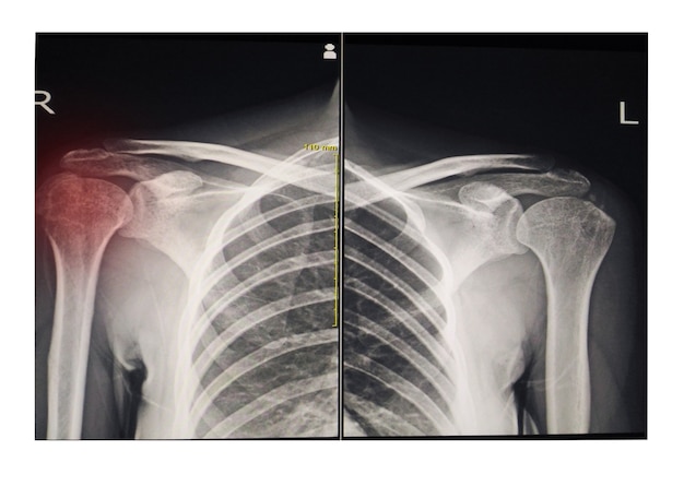 Filmröntgen beide schouder ap (vooraanzicht) vertonen breuken