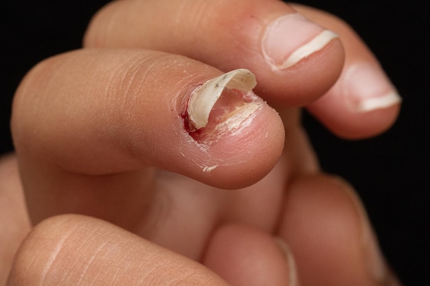 Finger nail comeoff after injury or disease