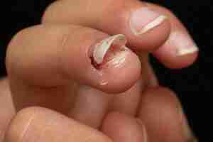 Photo finger nail comeoff after injury or disease