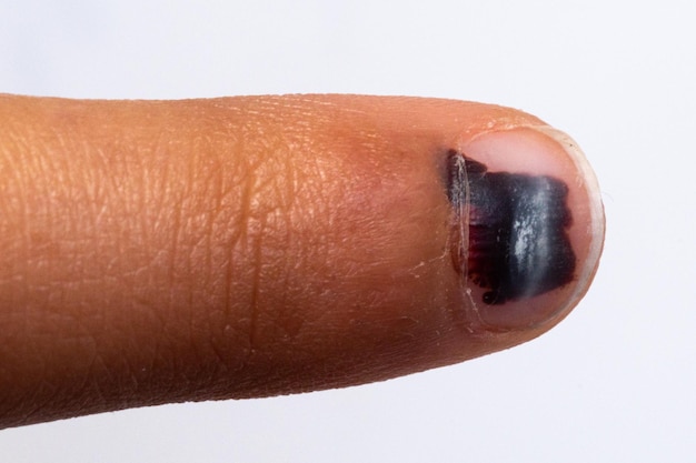 Finger with black nail due to trauma