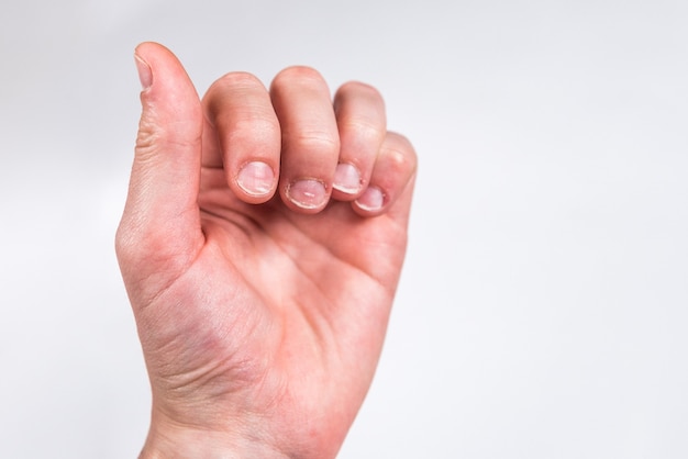 Fingers with badly or chewed bitten nails on gray wall.