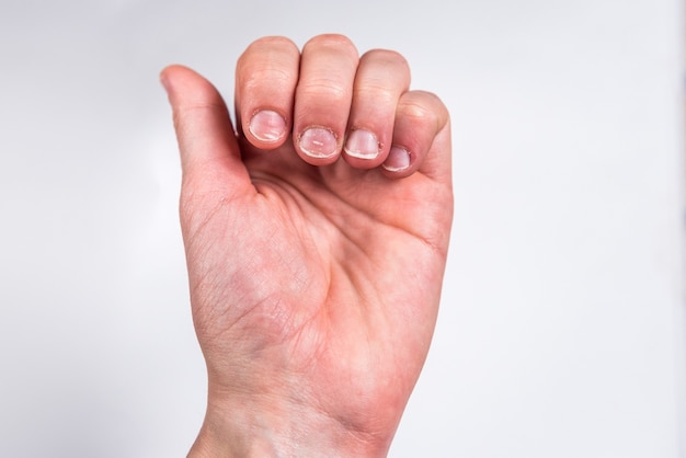 Fingers with badly or chewed bitten nails on gray wall.